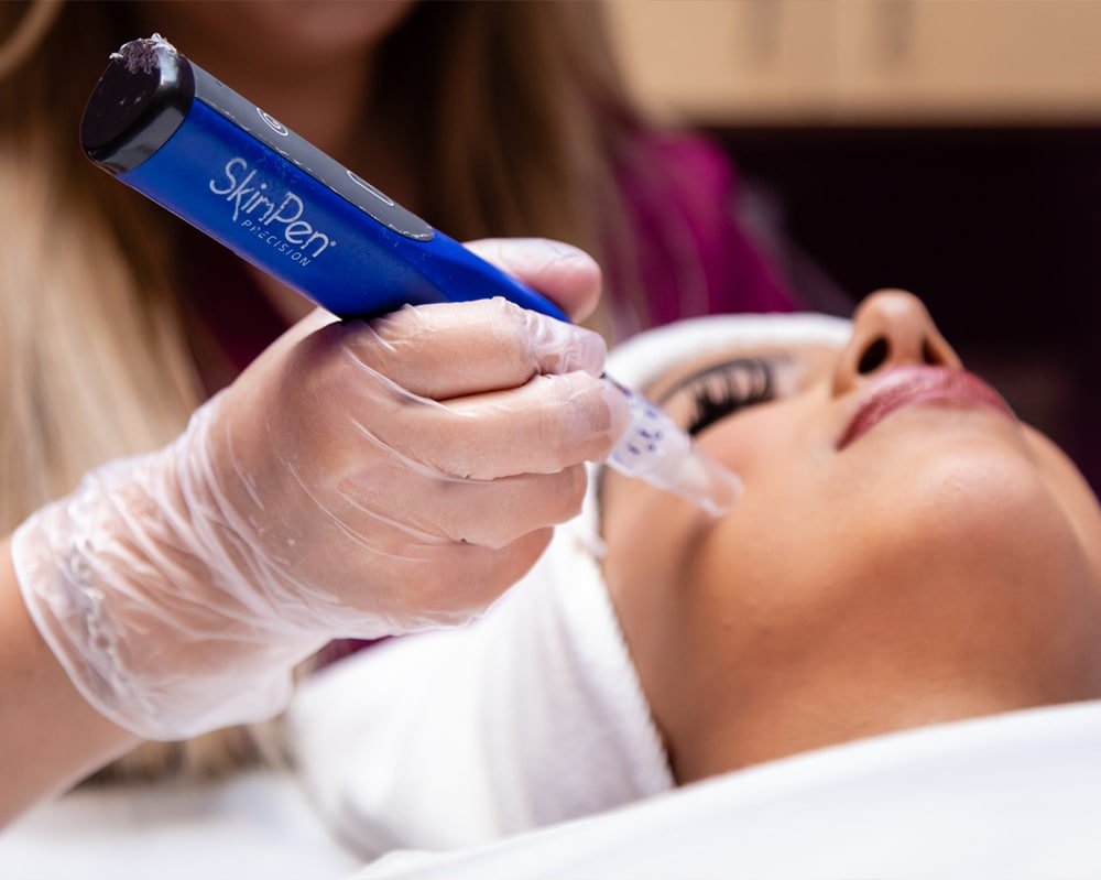 SkinPen microneedling Treatment in Savannah, GA 