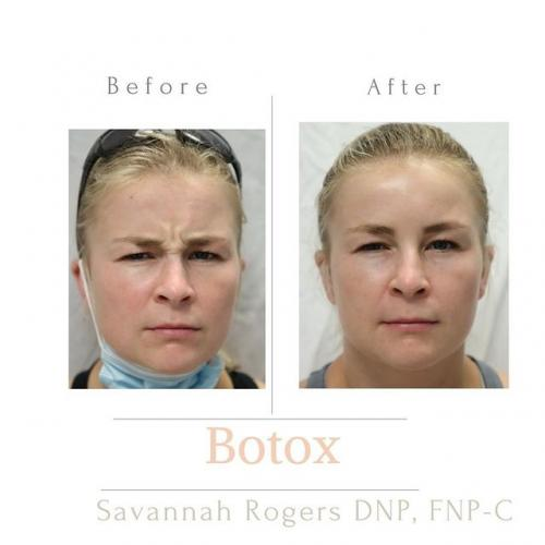 Patient consultation before Botox treatment at Aesthetically Savy