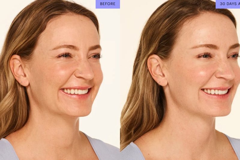 Botox in Savannah