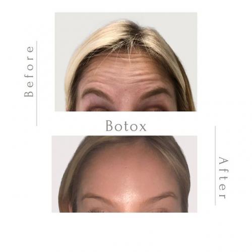 Botox-before-and-after