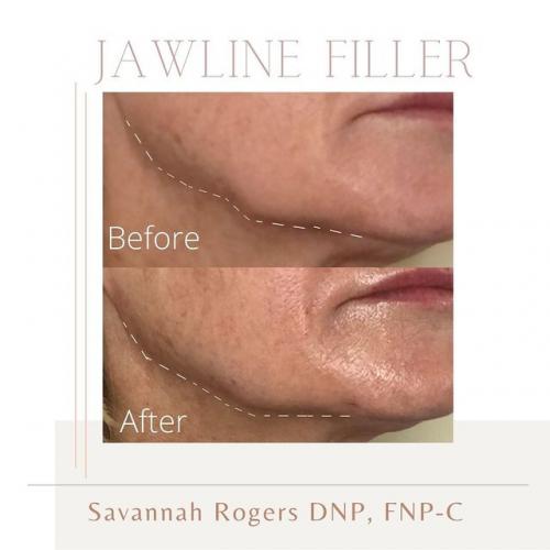 Jawline-Filler-Before-and-after-images