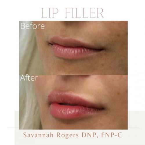 Lip-Filler-before-and-after-image