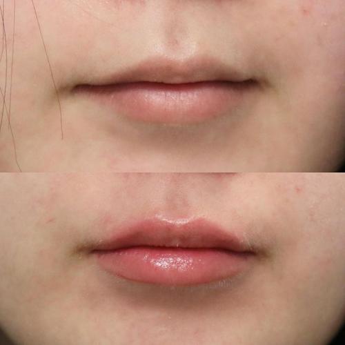 Lip-lines-Before-after